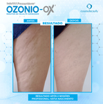 InduMAX Pressuriderm Ozone-Ox